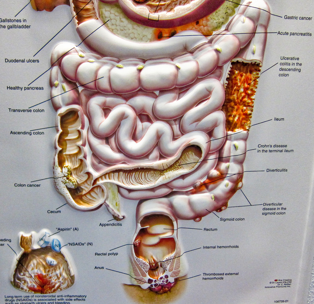 Colonoscopy: Do you need one?