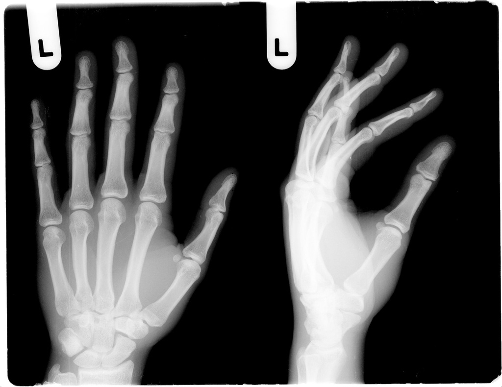 Do you need a bone scan?