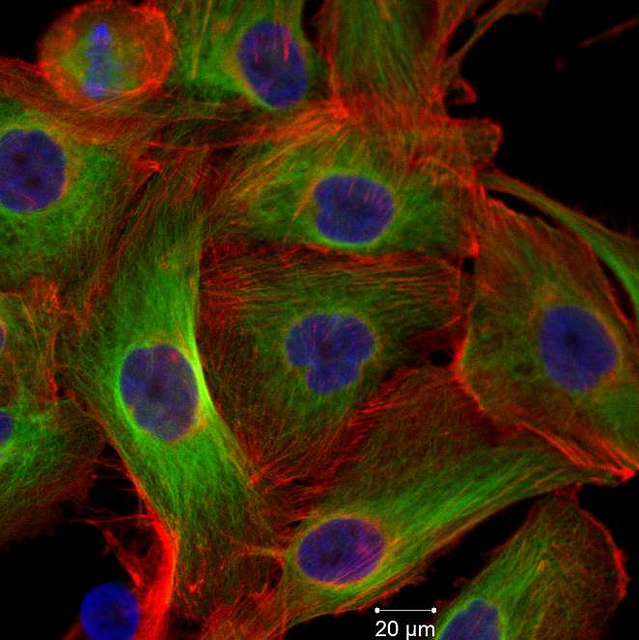 Medical device to remove fibroids causes cancer to spread