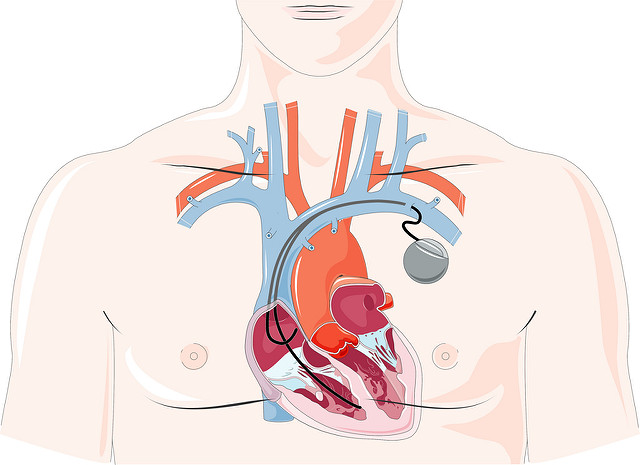 Can your pacemaker be hacked?