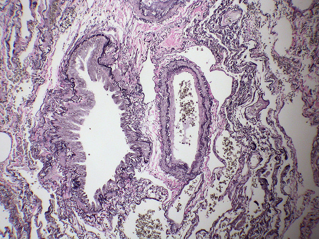 Risks of lung cancer screening may outweigh benefits