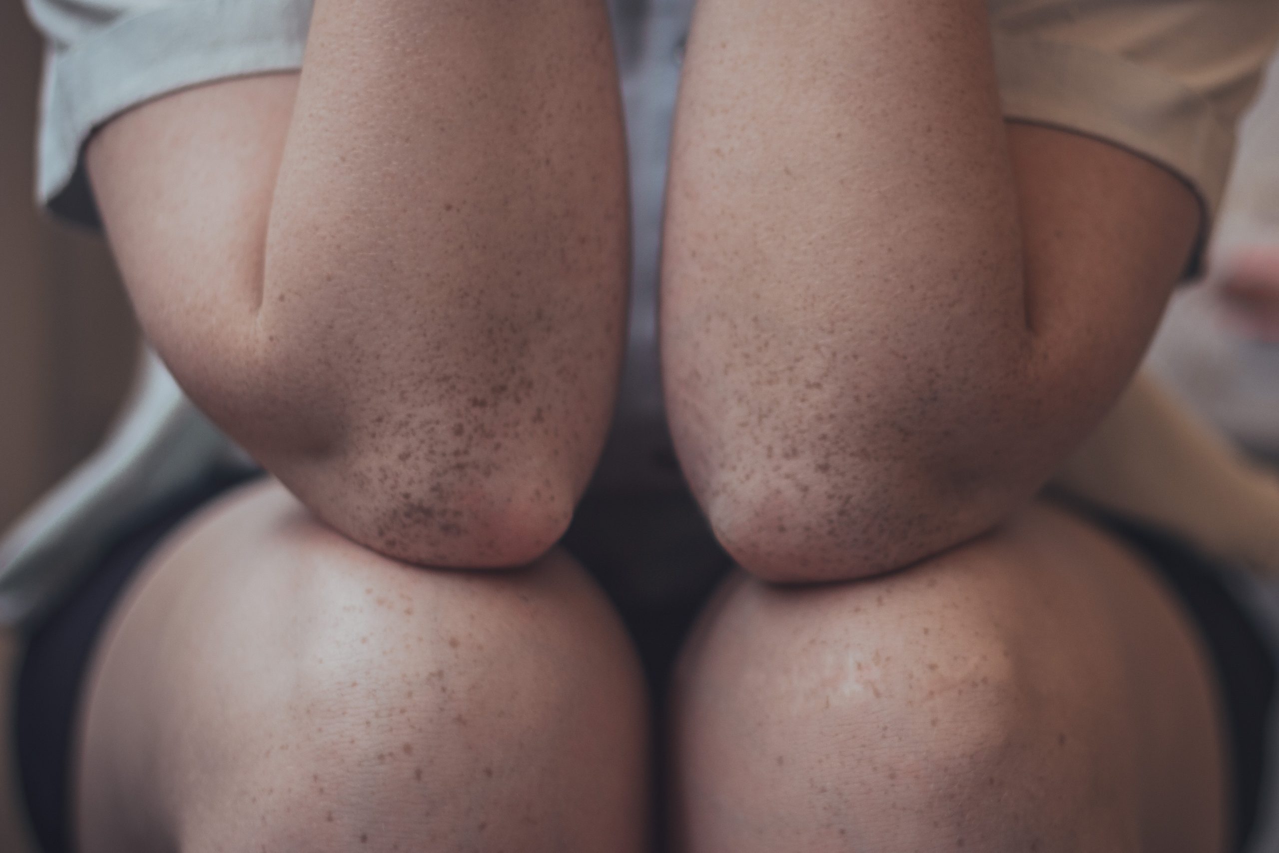 Have arthritis? Beware of corticosteroid injections